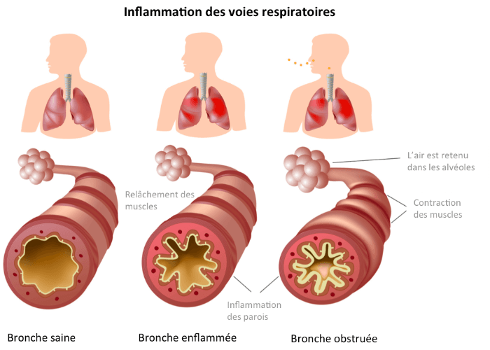 Hommes et femmes inégaux devant les maladies respiratoires