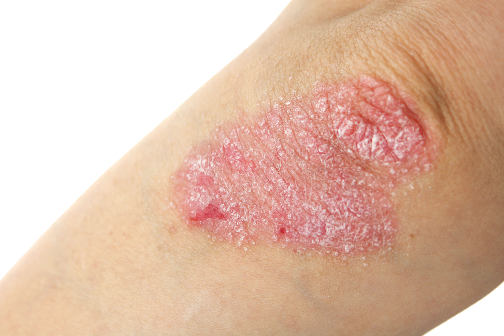 Psoriasis : Symptômes et traitement