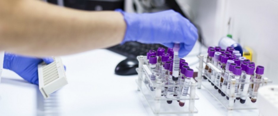 Un test sanguin de routine prédit la durée de survie des patients atteints d'un cancer