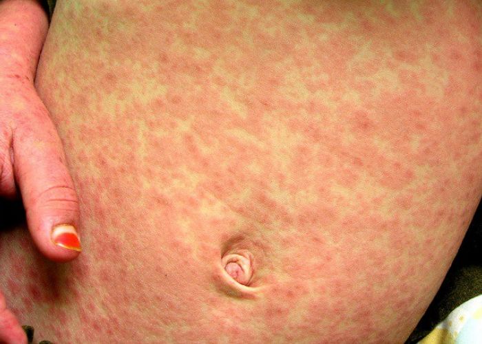 Rougeole : Six décès et 3 075 cas identifiés , selon un nouveau bilan