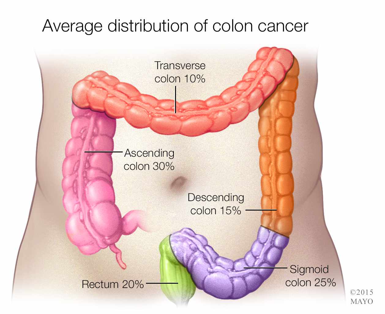 Les 4 signes du cancer du côlon qui ne se trompe jamais … Soyez attentifs à leur apparition !