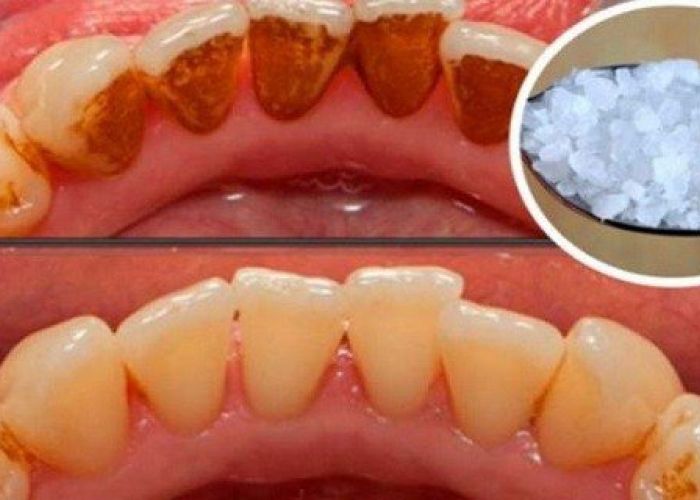 Voici comment blanchir des dents extrêmement jaunes et supprimer les plaques de tartre incrustées !