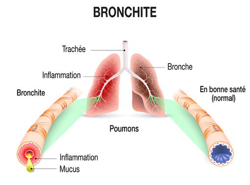 Soigner un bronchite aiguë infectieuse