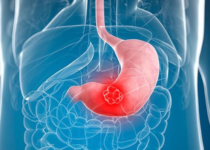 Cet aliment favorise le cancer de l’estomac. N’en mangez plus !