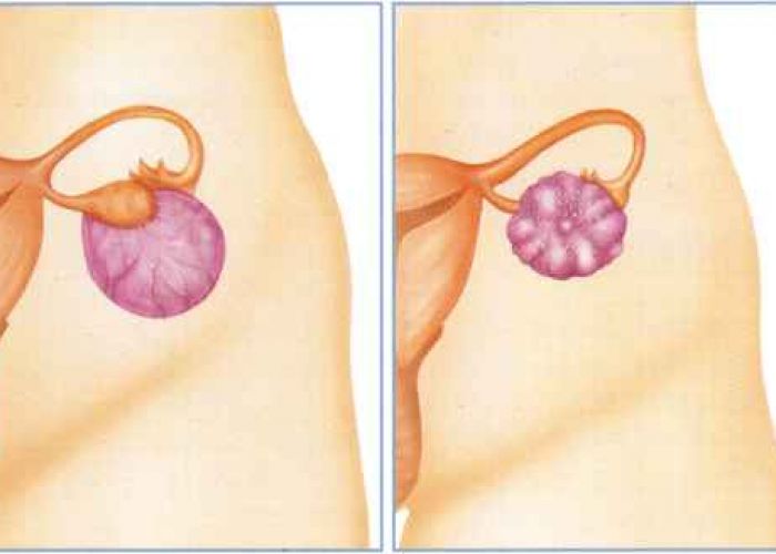 Vous doublez votre risque de cancer des ovaires en faisant ceci