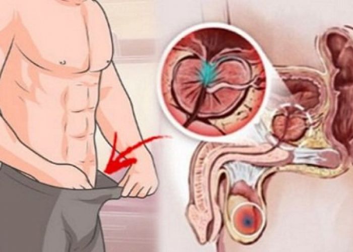 Douze symptômes avant-coureurs du cancer de la prostate que tous les hommes doivent connaitre !