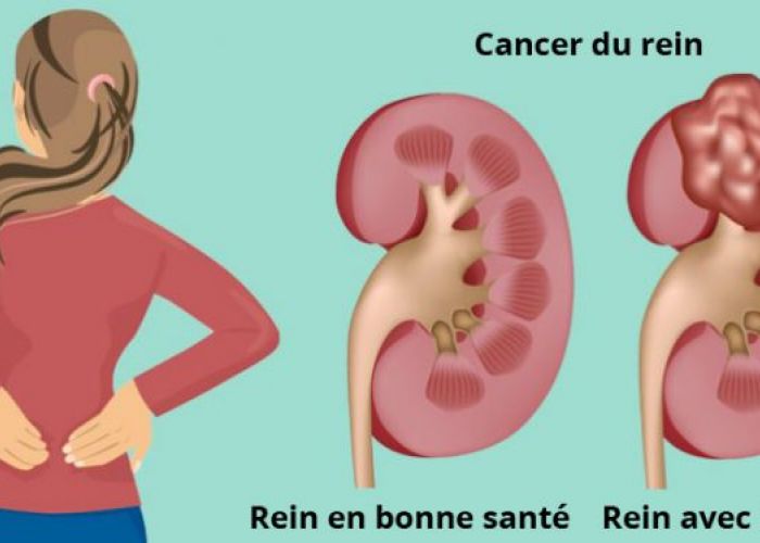 Sept signes qu’un cancer se développe dans les reins