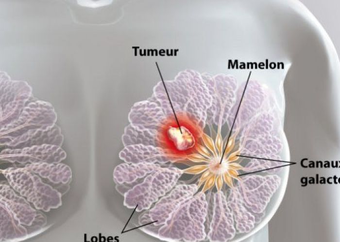 Des scientifiques ont détruit des cellules du cancer du sein en 11 jours, sans chimiothérapie