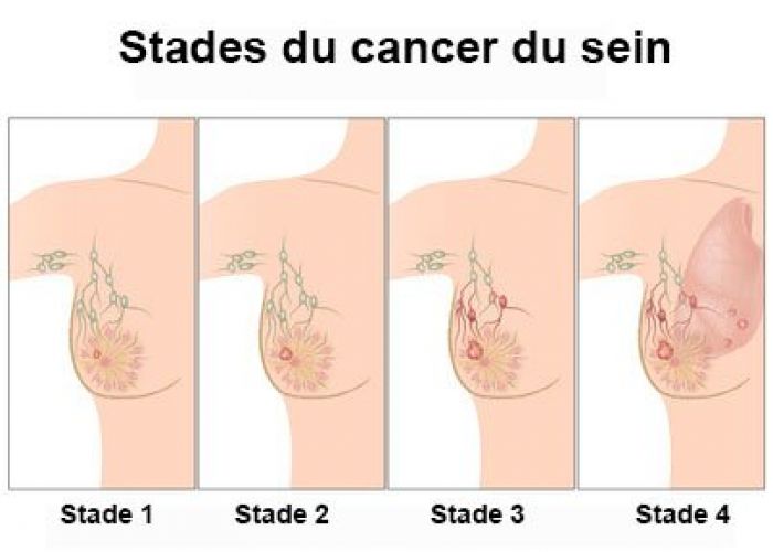 Cette cause du cancer du sein dont personne ne vous parle