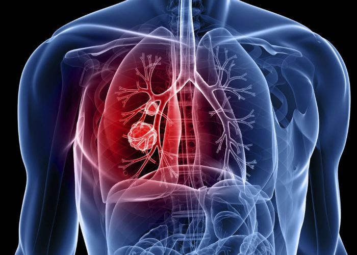 Douze preuves que le cancer des poumons se développe dans votre corps