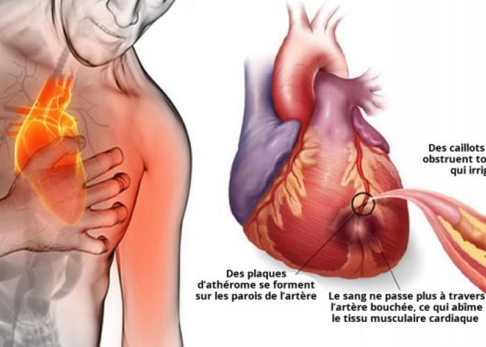 80% des crises cardiaques pourraient être évitées si tout le monde faisait ceci