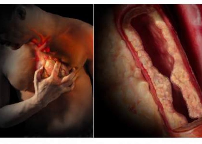 Voici comment augmenter vos chances de survivre à une crise cardiaque
