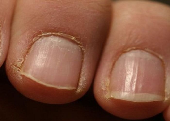 Alerte rouge : si vous voyez cela sur vos ongles consultez immédiatement un médecin !