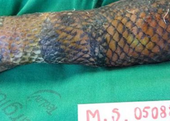 De la peau de poisson pour soigner les brûlures
