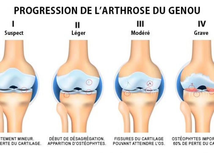Voici comment soigner vos douleurs d’arthrose naturellement