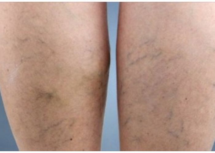 Voici comment se débarrasser des varices