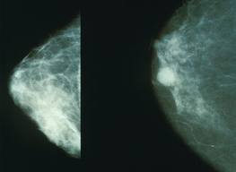 CNAS : 2013, année de la prévention contre le cancer du sein