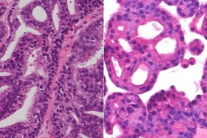 USA: lancement du plus vaste essai clinique en médecine de précision du cancer